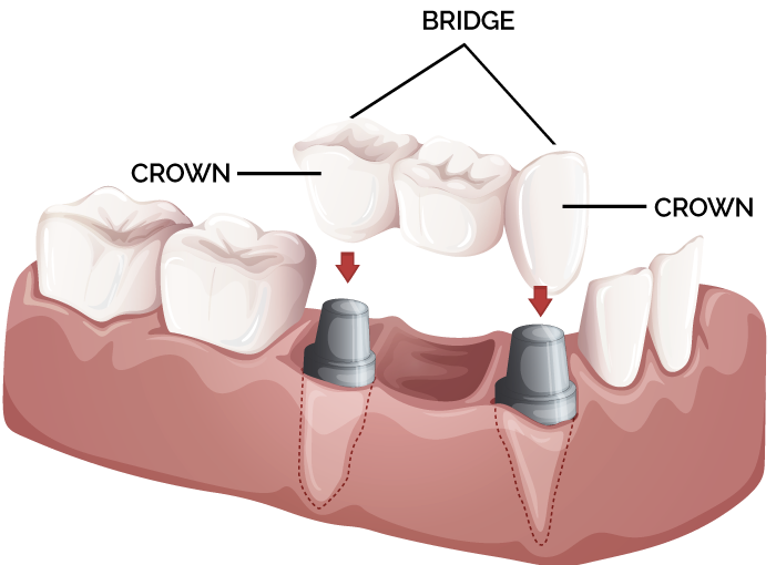 Crowns & Bridges