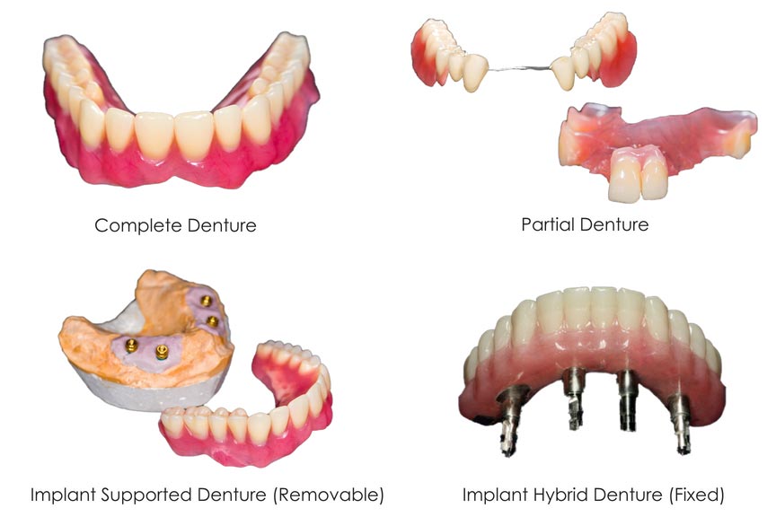 Dental Implants