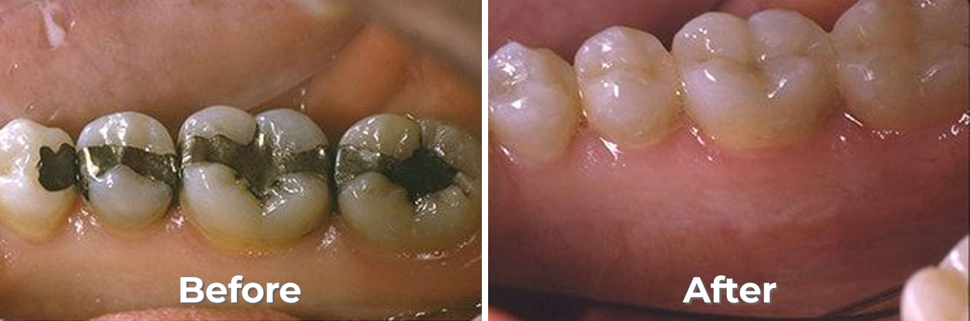 Dental Implants
