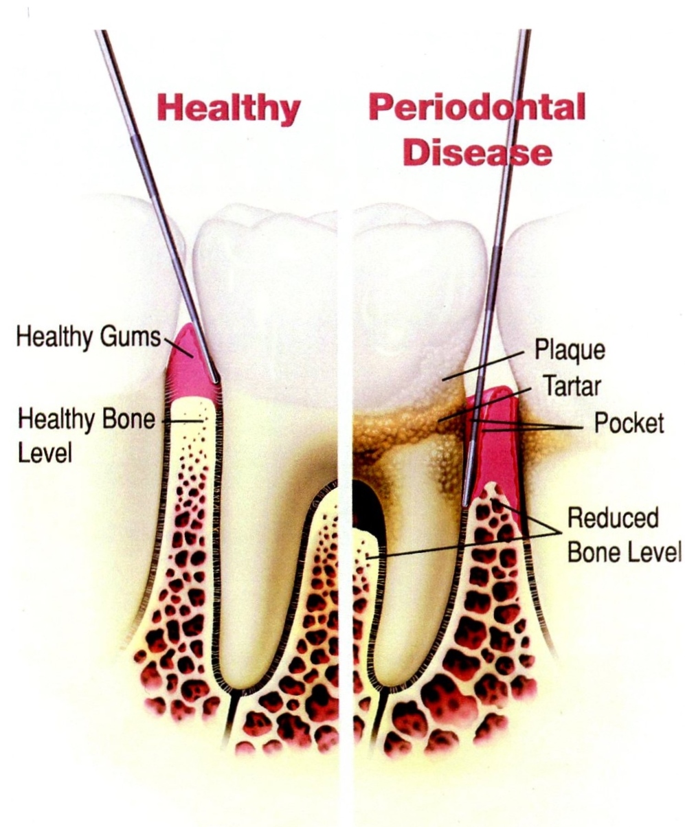 Perio Disease