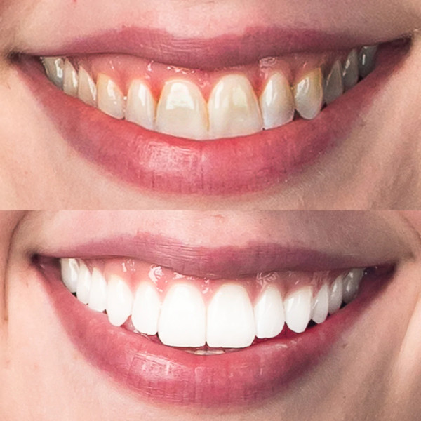 Teeth Whitening